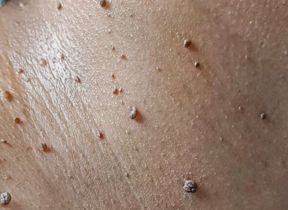Skin-tags-along-the-neck-1296x728-gallery_slide2