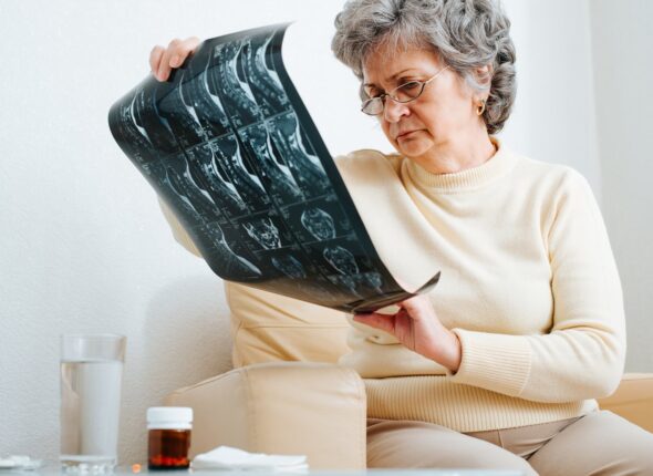 Osteoporoza u menopauzi: zašto kosti slabe i šta se može učiniti