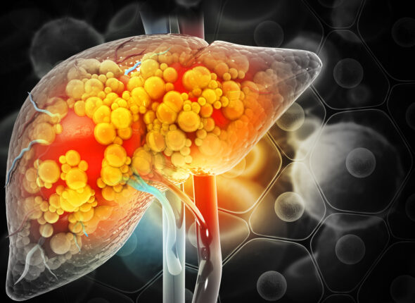 AlcoholicLiverDisease_Blog